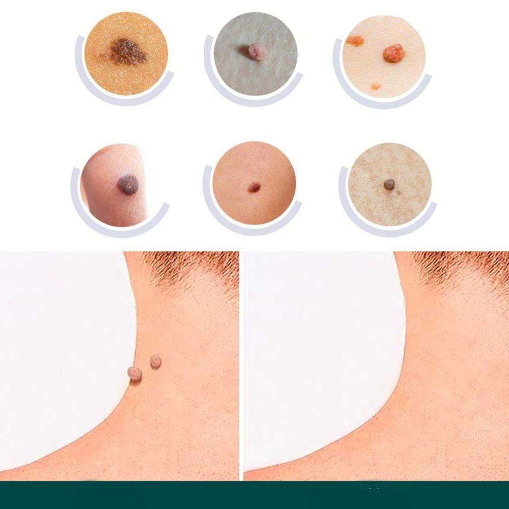 Skin Tag Remover Hydrocolloid Patches - Image 3